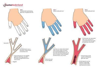 Behandeling van het Primaire Fenomeen van Raynaud