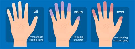 Symptomen van de Ziekte van Raynaud